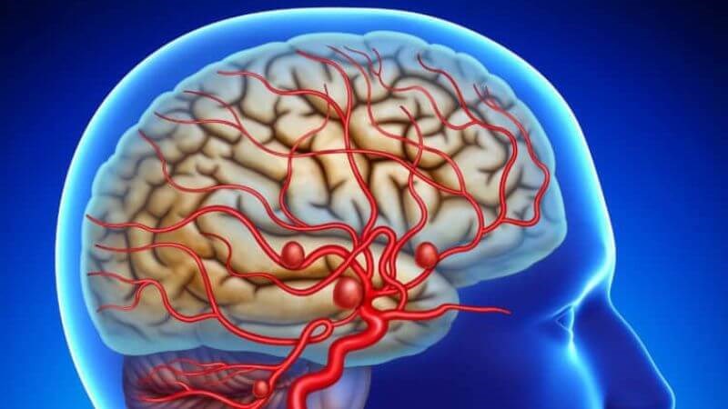 Phình Động Mạch Não: Khi Nào Cần Điều Trị?