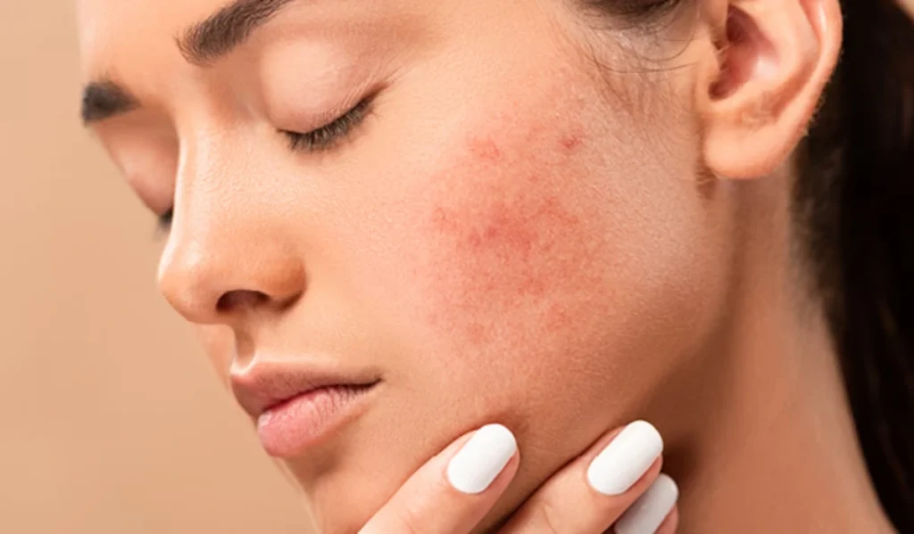 Sẩn Dạng Lympho: Đừng Chủ Quan Với Những Tổn Thương Da Kéo Dài